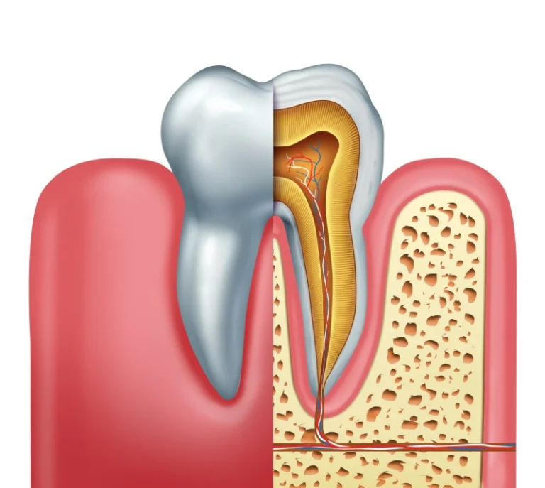 When a root canal may be needed blog by Ferris Family Dentistry.